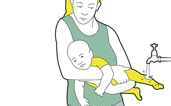 Baby minor burns and scalds - cool the burn or scald as quickly as possible