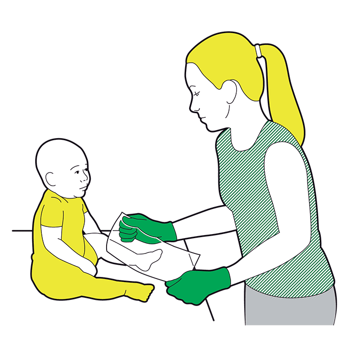 Baby minor burns and scalds - cover the area loosely with cling film