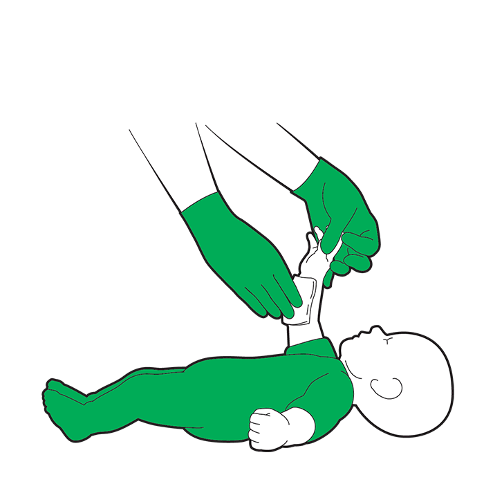 Baby severe bleed first aid - apply direct pressure to the wound