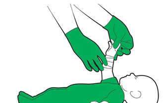 Baby severe bleed first aid - check their circulation beyond the bandage