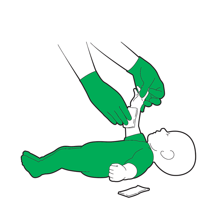 Baby severe bleed first aid - if blood seeps through both dressings, remove and replace with fresh dressing